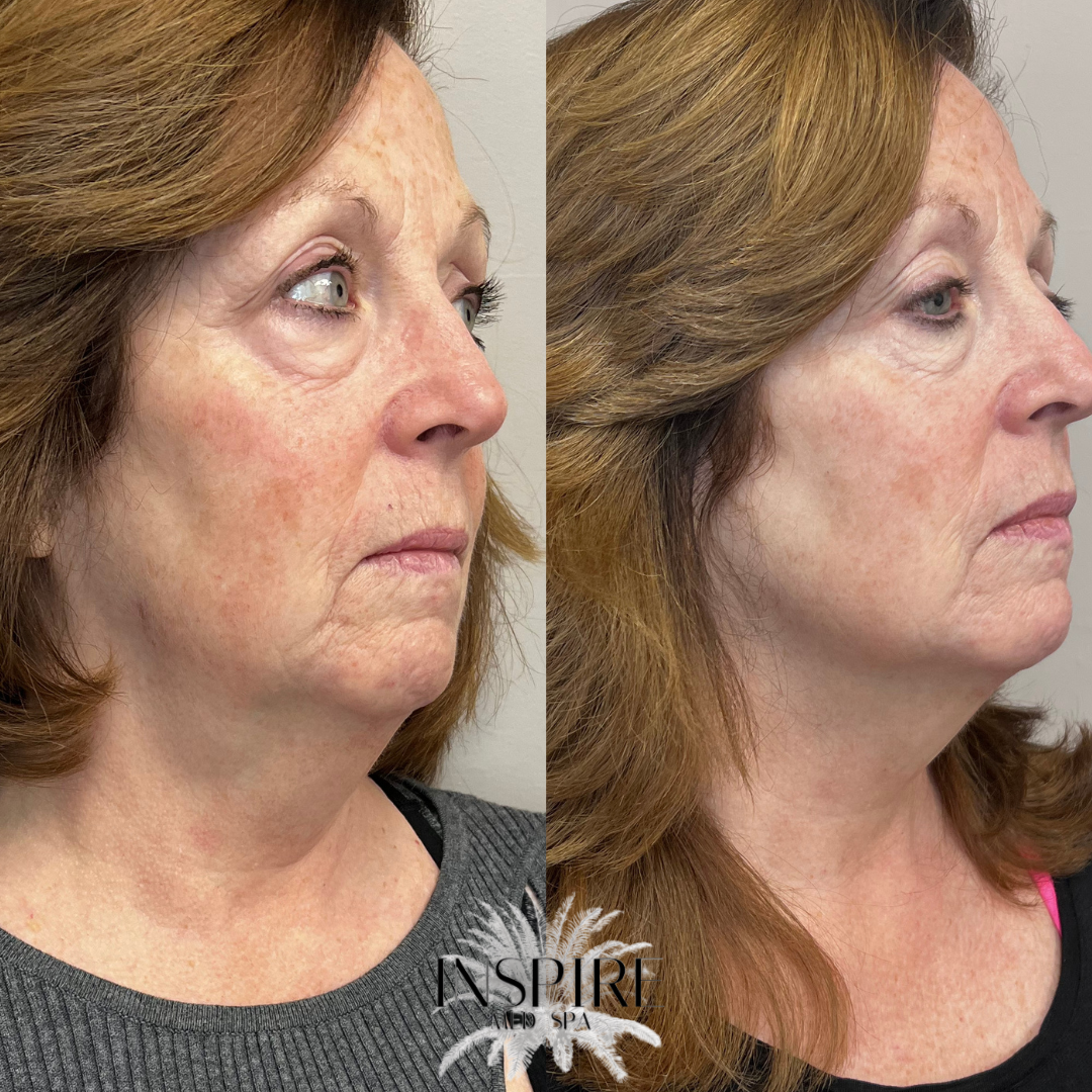 before and after of AGNES RF micro needling, jawline and neck contouring. left shows before procedure and right shows 3 months after 1st treatment.