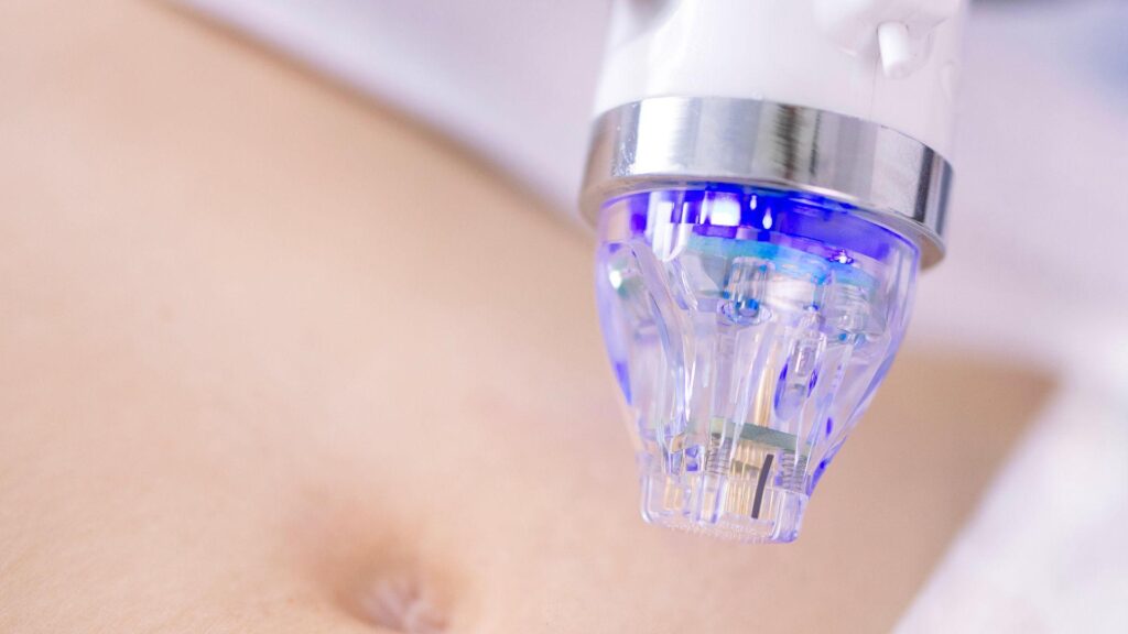 Key Benefits of RF Microneedling