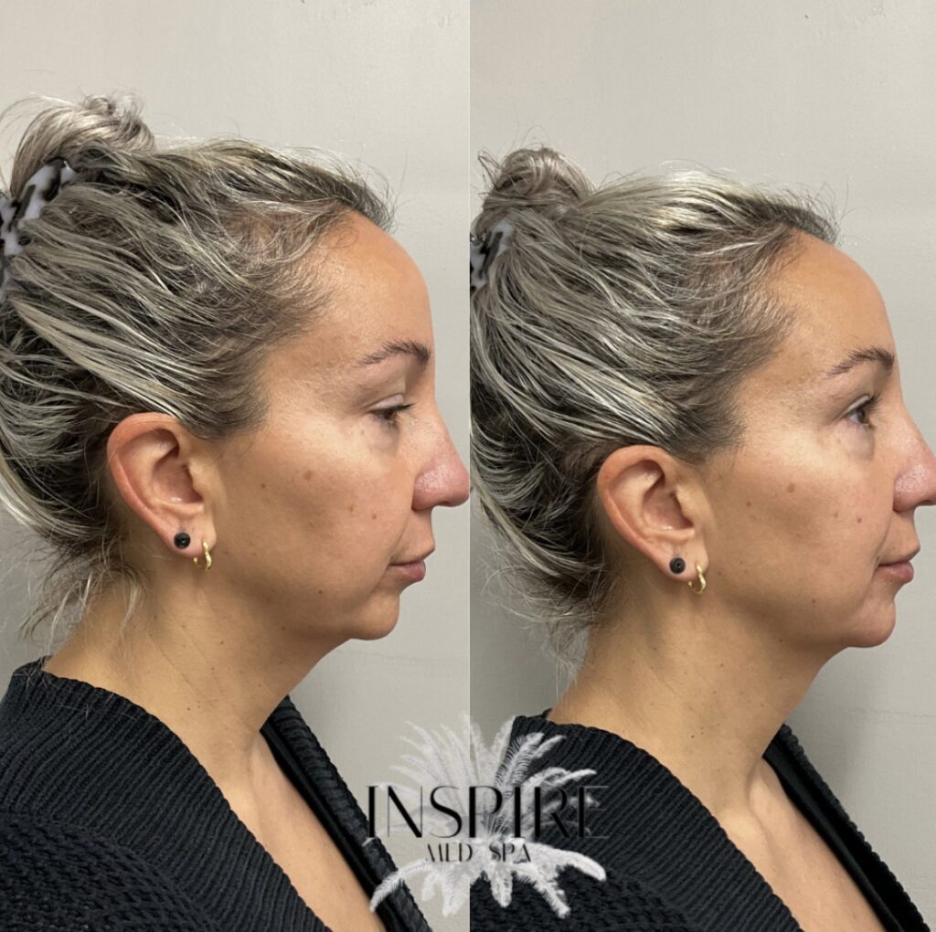 Calcium Hydroxylapatite Fillers