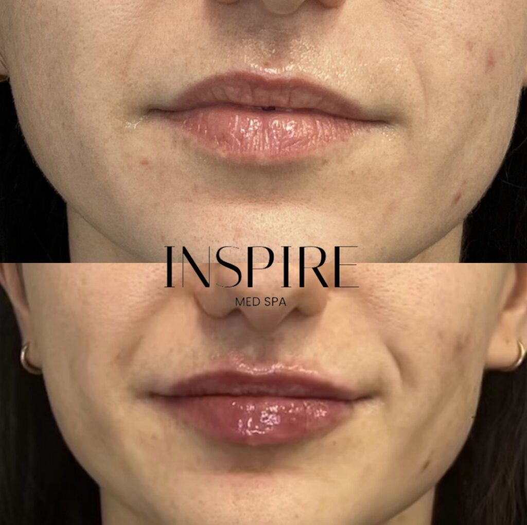 Hyaluronic Acid Fillers